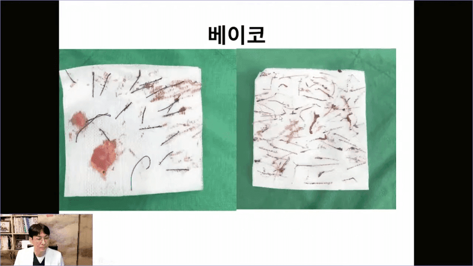 베이코 코실리프팅 후 이물질 제거, 왜 하게 될까 — 실이 문제가 되는 경우 관련 이미지 10/16