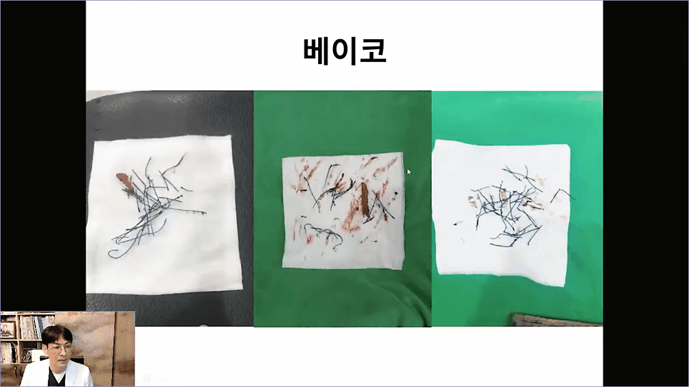 베이코 코실리프팅 후 이물질 제거, 왜 하게 될까 — 실이 문제가 되는 경우 관련 이미지 11/16