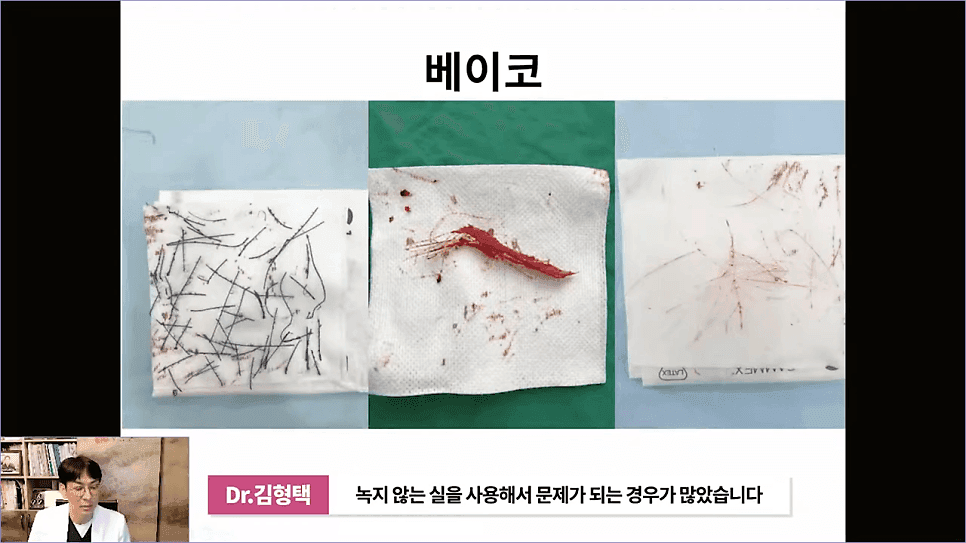 베이코 코실리프팅 후 이물질 제거, 왜 하게 될까 — 실이 문제가 되는 경우 관련 이미지 12/16