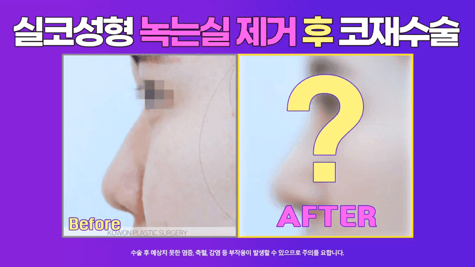 코실제거 후 비중격 연골로 코끝을 올린 재수술 사례 — 실코성형 제거가 까다로운 이유 관련 이미지 1/8