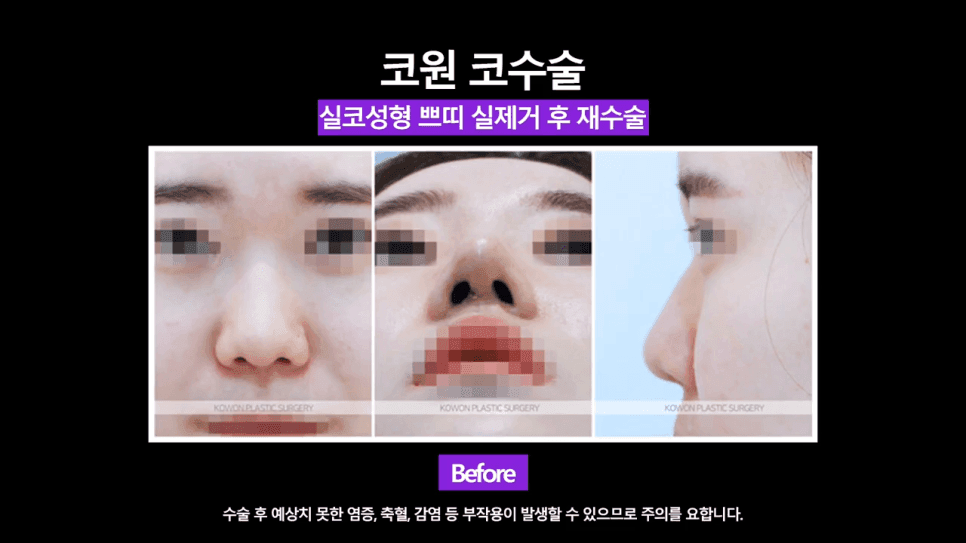 코실제거 후 비중격 연골로 코끝을 올린 재수술 사례 — 실코성형 제거가 까다로운 이유 관련 이미지 2/8