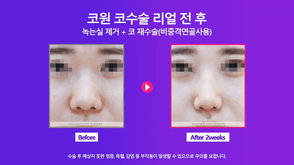 코실제거 후 비중격 연골로 코끝을 올린 재수술 사례 — 실코성형 제거가 까다로운 이유 관련 이미지 5/8