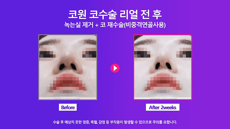 코실제거 후 비중격 연골로 코끝을 올린 재수술 사례 — 실코성형 제거가 까다로운 이유 관련 이미지 6/8