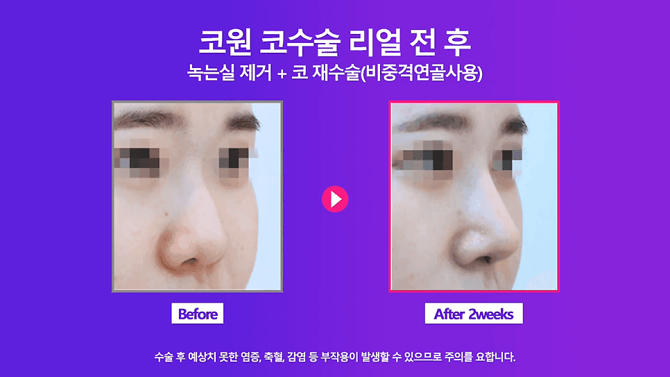 코실제거 후 비중격 연골로 코끝을 올린 재수술 사례 — 실코성형 제거가 까다로운 이유 관련 이미지 7/8