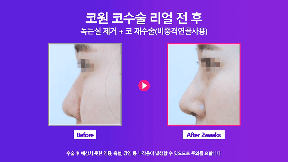 코실제거 후 비중격 연골로 코끝을 올린 재수술 사례 — 실코성형 제거가 까다로운 이유 관련 이미지 8/8