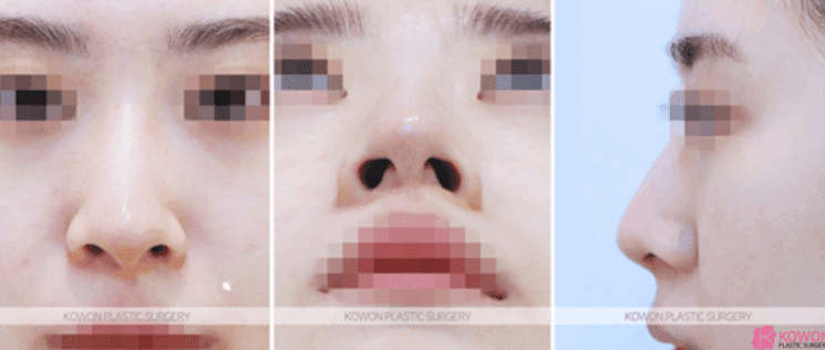 코끝수술 2주, 코가 낮아지고 콧볼이 넓어진 느낌 — 부작용일까요, 회복 과정일까요 관련 이미지 4/9