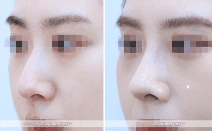 코끝수술 2주, 코가 낮아지고 콧볼이 넓어진 느낌 — 부작용일까요, 회복 과정일까요 관련 이미지 6/9