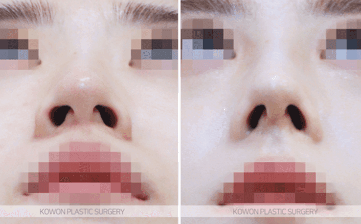코끝수술 2주, 코가 낮아지고 콧볼이 넓어진 느낌 — 부작용일까요, 회복 과정일까요 관련 이미지 8/9