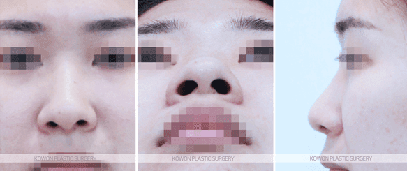 코끝연골재배치로 복코 라인이 정리되는 과정 — 지지 구조와 비순각·인중 균형까지 관련 이미지 4/9