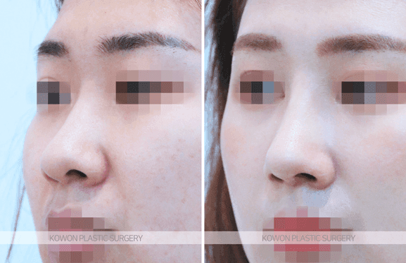 코끝연골재배치로 복코 라인이 정리되는 과정 — 지지 구조와 비순각·인중 균형까지 관련 이미지 5/9