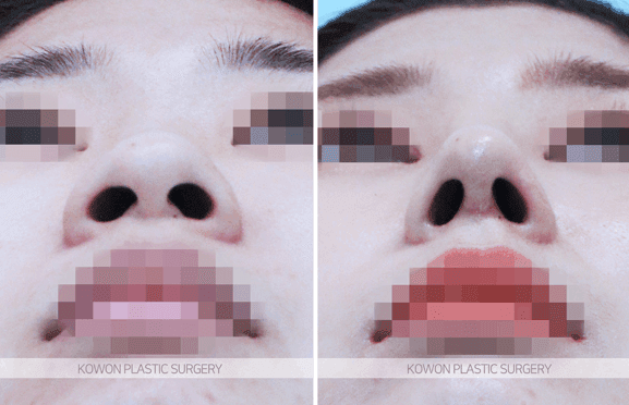 코끝연골재배치로 복코 라인이 정리되는 과정 — 지지 구조와 비순각·인중 균형까지 관련 이미지 6/9