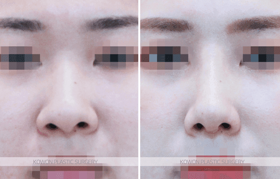 코끝연골재배치로 복코 라인이 정리되는 과정 — 지지 구조와 비순각·인중 균형까지 관련 이미지 7/9