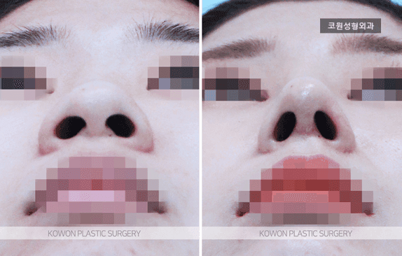 코끝연골재배치로 얼굴 중심 입체감을 살리는 자려한 코라인 — 복코에서 무엇을 함께 보나 관련 이미지 3/6