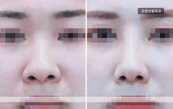 코끝연골재배치로 얼굴 중심 입체감을 살리는 자려한 코라인 — 복코에서 무엇을 함께 보나 관련 이미지 4/6