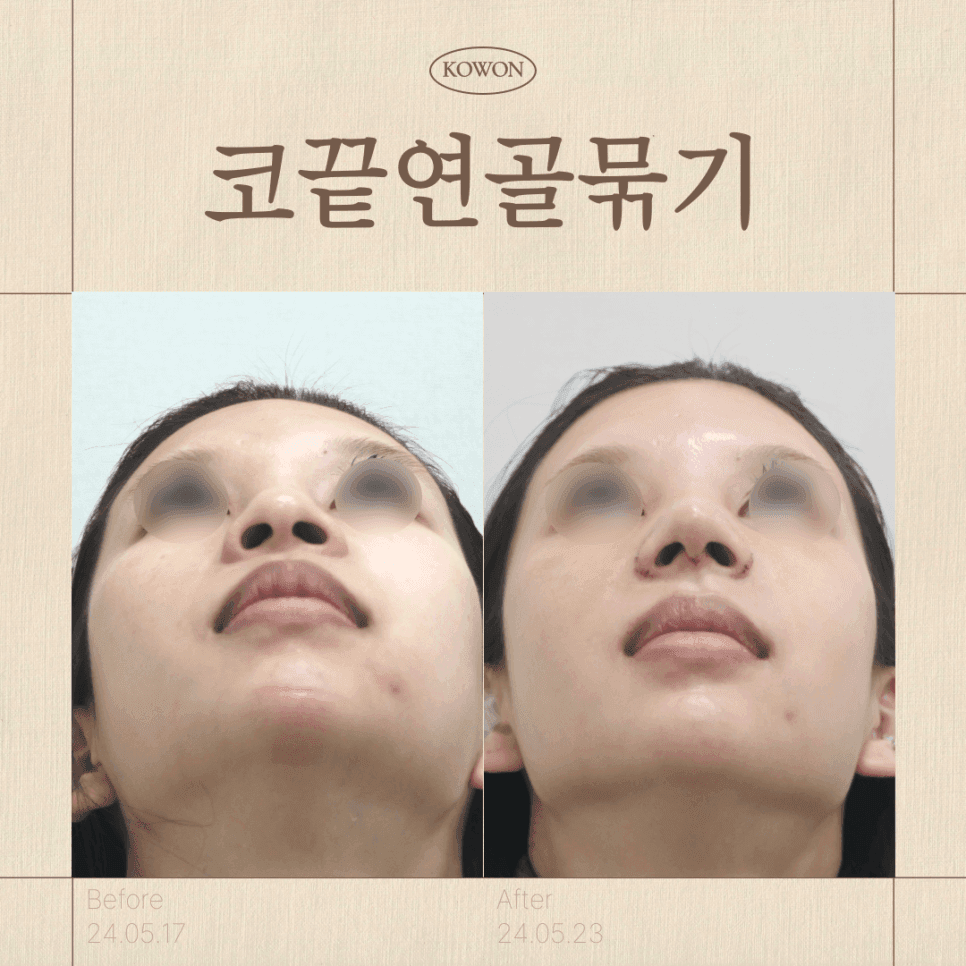 การเย็บกระดูกอ่อนเพียงอย่างเดียวเพียงพอสำหรับปลายจมูกหรือไม่? — เกณฑ์โครงสร้างที่ควรตรวจสอบก่อนตัดสินใจผ่าตัดปลายจมูกกลมใหญ่ป่อง ภาพประกอบ 1/2