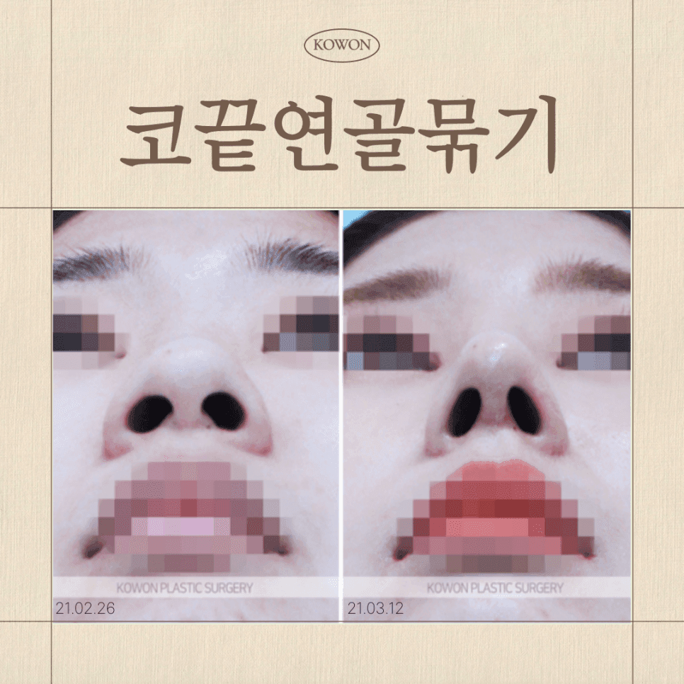 코끝연골묶기, 복코도 묶기만으로 충분할까 — 가능한 구조와 부족한 구조 관련 이미지 1/8