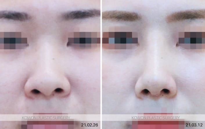 코끝연골묶기, 복코도 묶기만으로 충분할까 — 가능한 구조와 부족한 구조 관련 이미지 8/8
