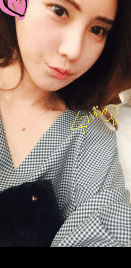 수술 후 코끝처짐, 개선 방법이 코재수술밖에 없나요? — 확인 순서와 수술 범위 관련 이미지 6/9