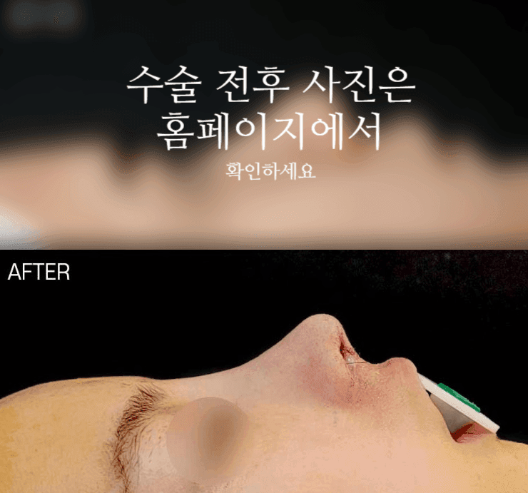 코끝연골재배치로 자려한 코를 만드는 3가지 포인트 — 콧대·코끝이 모두 낮은 작은 코라면 관련 이미지 2/9