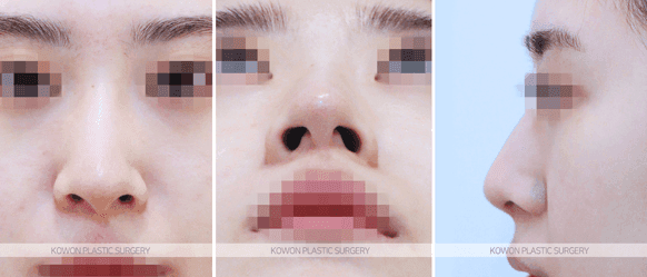 코끝연골재배치로 자려한 코를 만드는 3가지 포인트 — 콧대·코끝이 모두 낮은 작은 코라면 관련 이미지 4/9