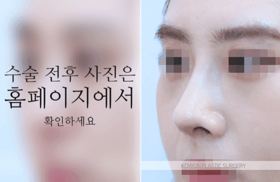 코끝연골재배치로 자려한 코를 만드는 3가지 포인트 — 콧대·코끝이 모두 낮은 작은 코라면 관련 이미지 5/9