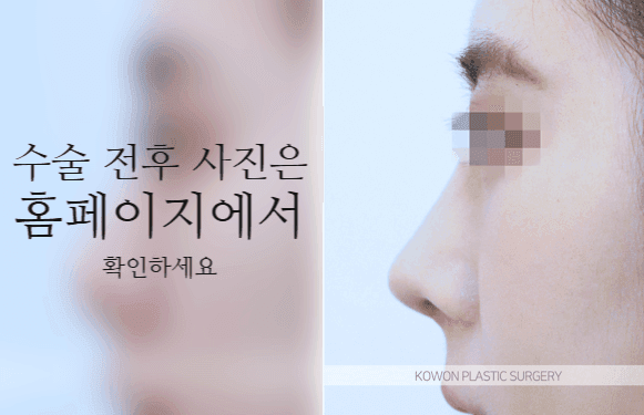 코끝연골재배치로 자려한 코를 만드는 3가지 포인트 — 콧대·코끝이 모두 낮은 작은 코라면 관련 이미지 6/9