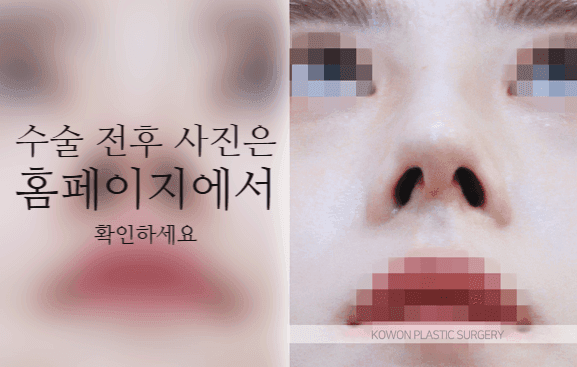 코끝연골재배치로 자려한 코를 만드는 3가지 포인트 — 콧대·코끝이 모두 낮은 작은 코라면 관련 이미지 7/9