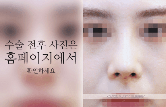 코끝연골재배치로 자려한 코를 만드는 3가지 포인트 — 콧대·코끝이 모두 낮은 작은 코라면 관련 이미지 8/9