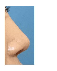 코끝재수술, 웃을 때 화살코가 되는 뭉툭한 코끝 — 재료 탓일까요, 근육 탓일까요? 관련 이미지 5/8