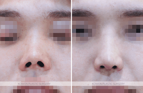 코끝재수술, 웃을 때 화살코가 되는 뭉툭한 코끝 — 재료 탓일까요, 근육 탓일까요? 관련 이미지 7/8