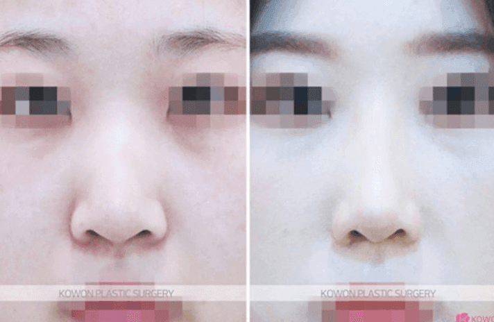 코끝재수술, 웃을 때 화살코가 되는 뭉툭한 코끝 — 재료 탓일까요, 근육 탓일까요? 관련 이미지 8/8