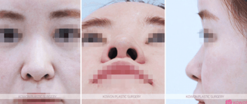작고 낮은 코의 코끝 연골묶기 — 지지 구조와 균형으로 라인을 만드는 과정 관련 이미지 5/10