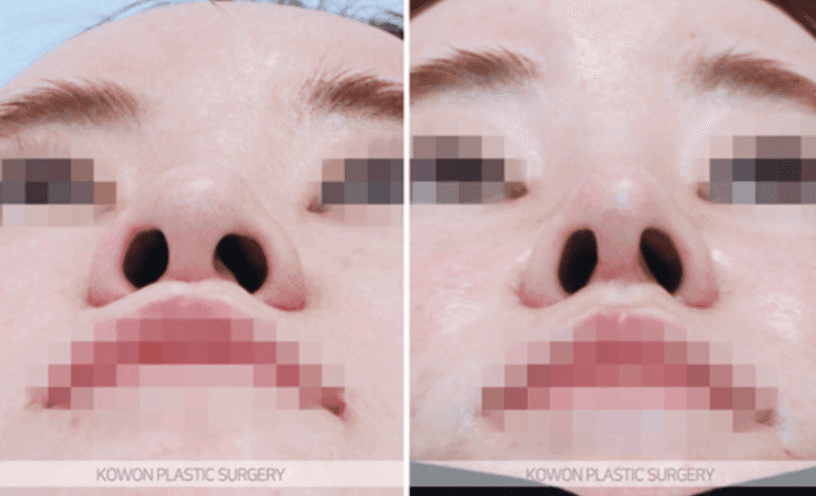 작고 낮은 코의 코끝 연골묶기 — 지지 구조와 균형으로 라인을 만드는 과정 관련 이미지 6/10