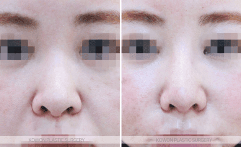 작고 낮은 코의 코끝 연골묶기 — 지지 구조와 균형으로 라인을 만드는 과정 관련 이미지 7/10