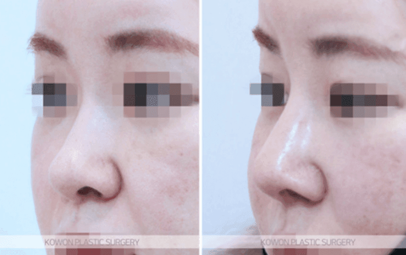 작고 낮은 코의 코끝 연골묶기 — 지지 구조와 균형으로 라인을 만드는 과정 관련 이미지 8/10