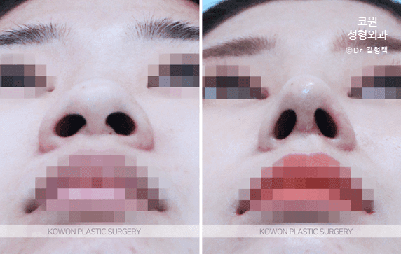 코끝 연골묶기 전후, 모으는 변화보다 중요한 것 — 방향·지지력·각도의 구조적 균형 관련 이미지 3/6