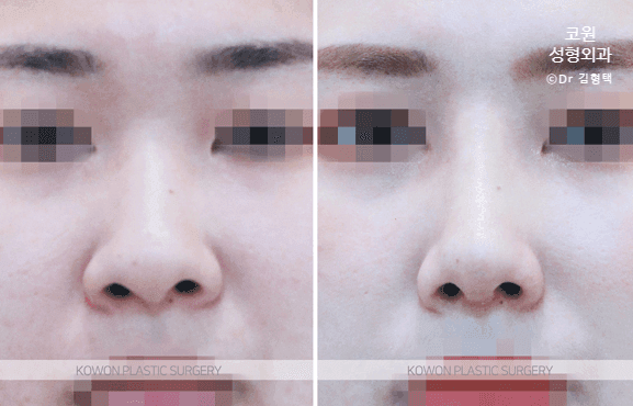 코끝 연골묶기 전후, 모으는 변화보다 중요한 것 — 방향·지지력·각도의 구조적 균형 관련 이미지 4/6