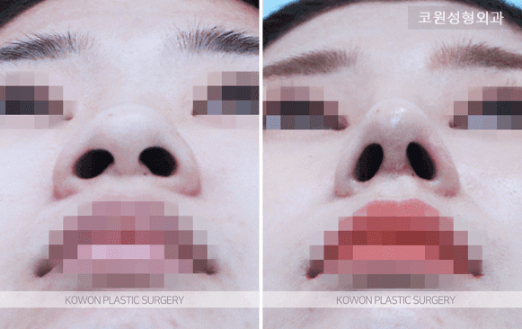 코끝연골묶기 후 붓기, 코끝만 아직 뭉툭해 보인다면 — 회복 흐름과 확인 기준 관련 이미지 3/5