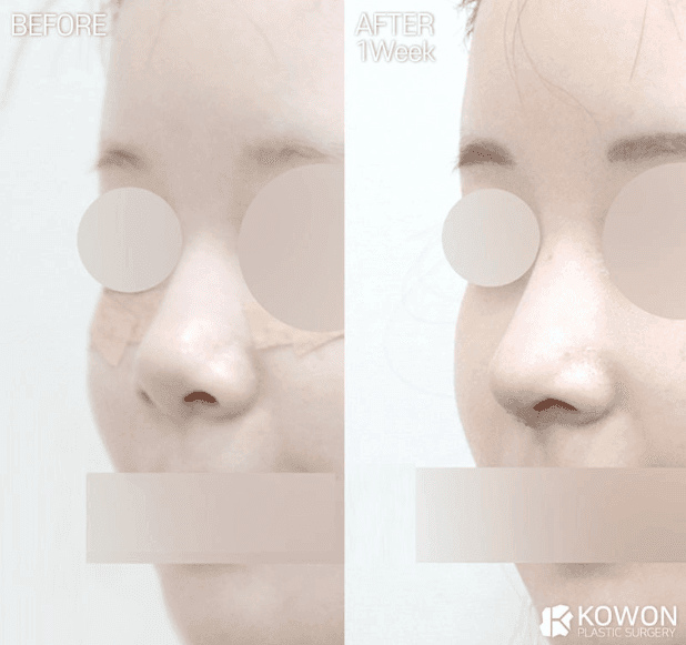 양악 수술을 하면 비중격 연골은 사용할 수 없나요? — 양악 후 코성형 재료 이야기 관련 이미지 2/5