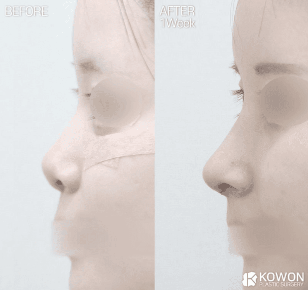 양악 수술을 하면 비중격 연골은 사용할 수 없나요? — 양악 후 코성형 재료 이야기 관련 이미지 4/5