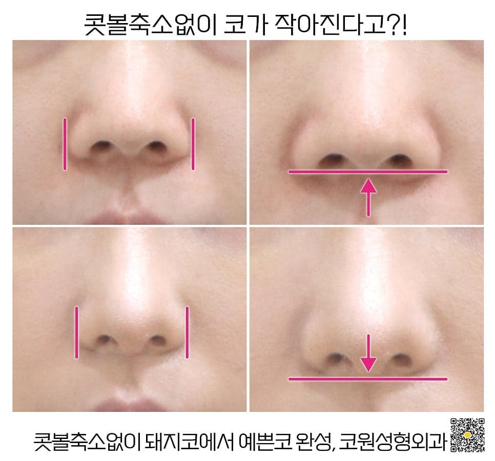 짧고 퍼진 들창코, 콧볼 축소 없이 개선할 수 있을까 — 코끝 연골 이식과 비순각 관련 이미지 2/5