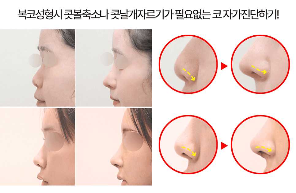 짧고 퍼진 들창코, 콧볼 축소 없이 개선할 수 있을까 — 코끝 연골 이식과 비순각 관련 이미지 3/5