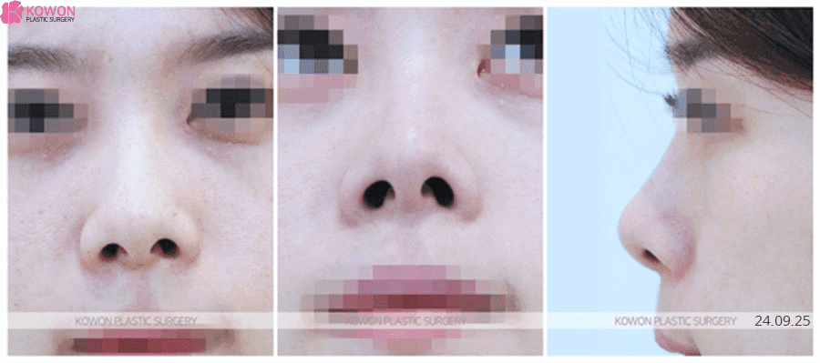 들창코수술 비용, 왜 상담 전에는 딱 잘라 말하기 어렵나요 — 범위·재료·병원 선택 기준 관련 이미지 2/9