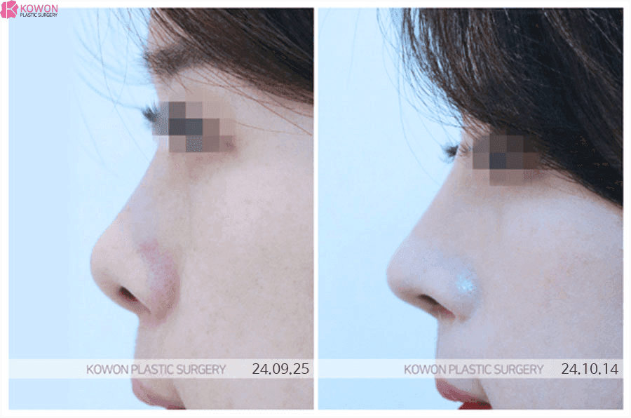 들창코수술 비용, 왜 상담 전에는 딱 잘라 말하기 어렵나요 — 범위·재료·병원 선택 기준 관련 이미지 3/9