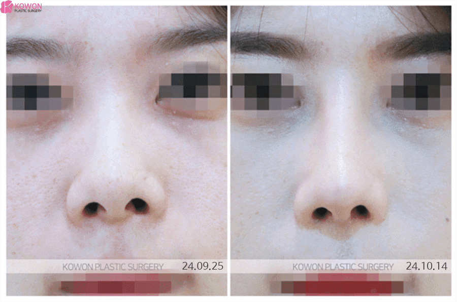 들창코수술 비용, 왜 상담 전에는 딱 잘라 말하기 어렵나요 — 범위·재료·병원 선택 기준 관련 이미지 4/9