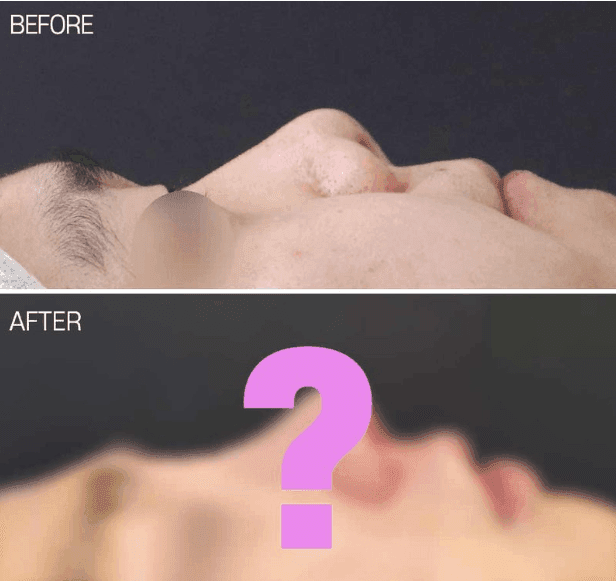 낮은코성형과 들창코 수술, 비중격만곡증까지 함께 교정할 수 있을까 — 사례로 보는 과정 관련 이미지 2/7