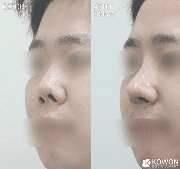 낮은코성형과 들창코 수술, 비중격만곡증까지 함께 교정할 수 있을까 — 사례로 보는 과정 관련 이미지 4/7