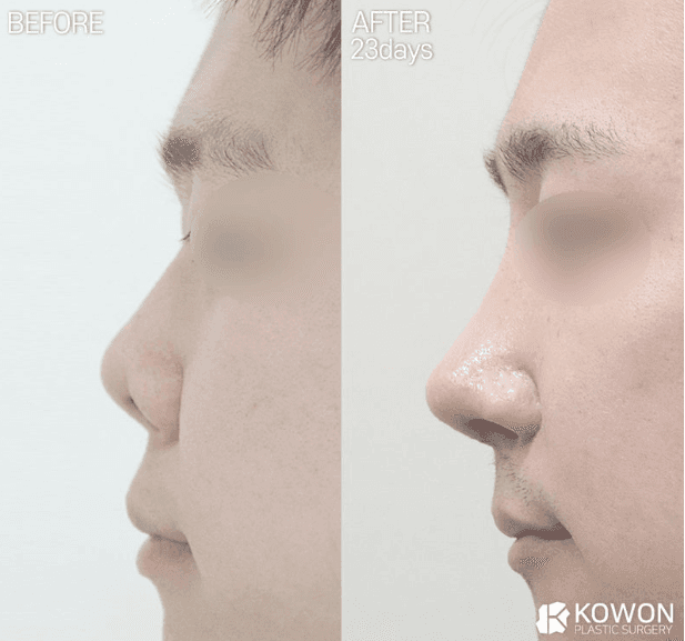 낮은코성형과 들창코 수술, 비중격만곡증까지 함께 교정할 수 있을까 — 사례로 보는 과정 관련 이미지 5/7