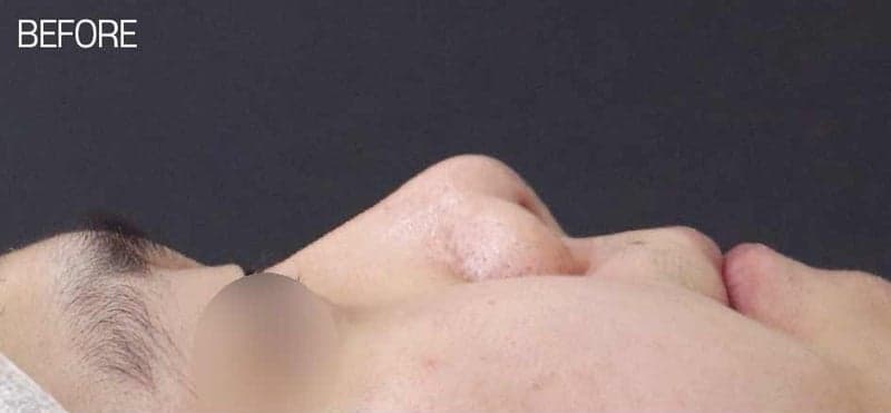 낮은코성형과 들창코 수술, 비중격만곡증까지 함께 교정할 수 있을까 — 사례로 보는 과정 관련 이미지 6/7