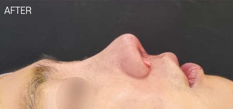 낮은코성형과 들창코 수술, 비중격만곡증까지 함께 교정할 수 있을까 — 사례로 보는 과정 관련 이미지 7/7